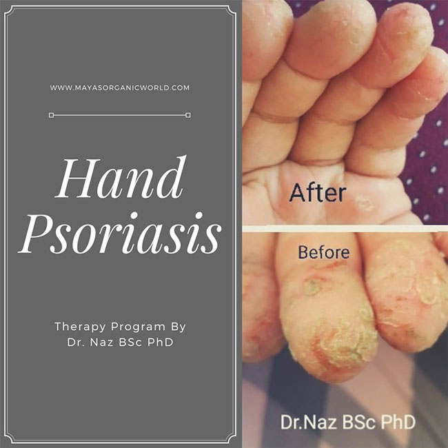 Hand Psoriasis